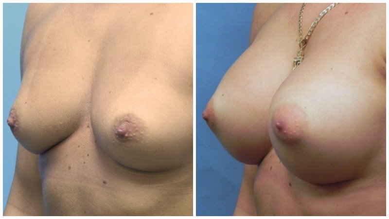 breast25