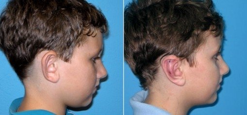 otoplasty2