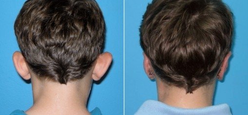 otoplasty3