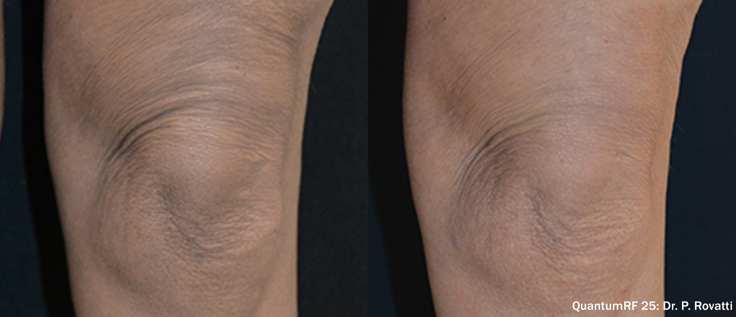 PR_QuantumRF_25_LKnee_Female_Front_TM