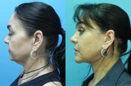 Before and After (1)