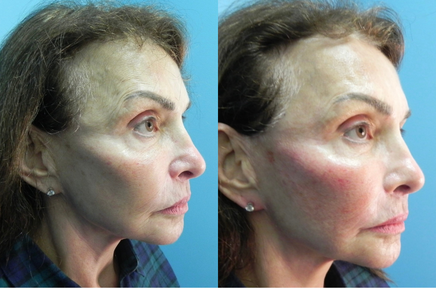 facelist-case-14-436 (1)